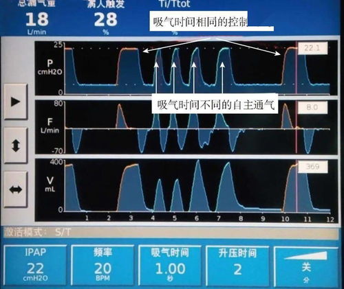 常见异常呼吸波形解读