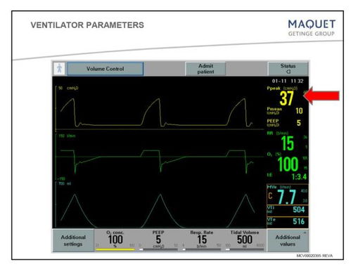 送给临床小白 呼吸机模式及参数设置图文详解