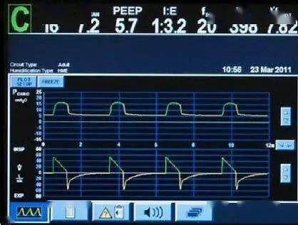 ICU必备工具 呼吸机ST模式的专业解读与临床应用